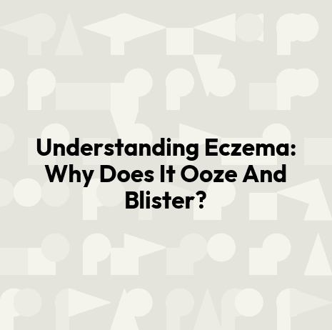 Understanding Eczema: Why Does It Ooze And Blister?